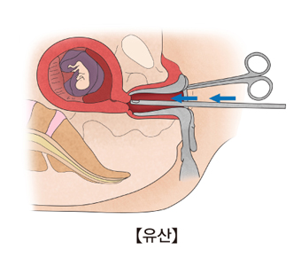 계류 유산