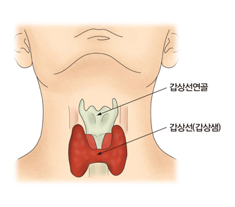 점액수종 혼수