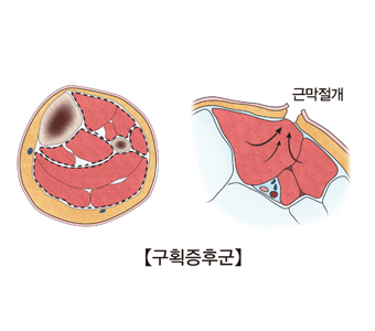 구획증후군