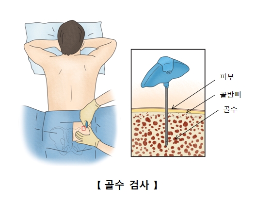 골수이형성증후군