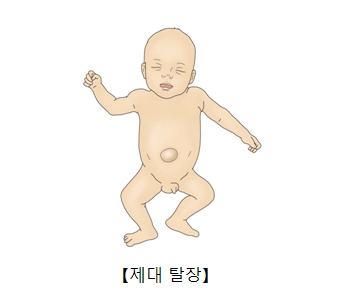 제대 탈장