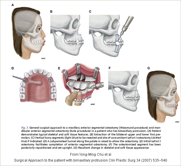 Indication of surgery