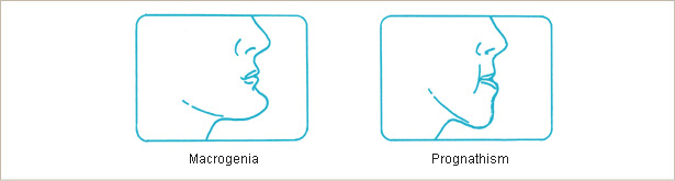 Mandibular prognathism