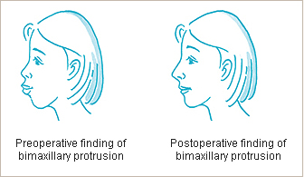 Postoperative care