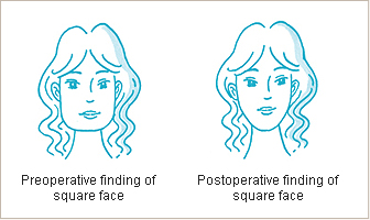 Postoperative care