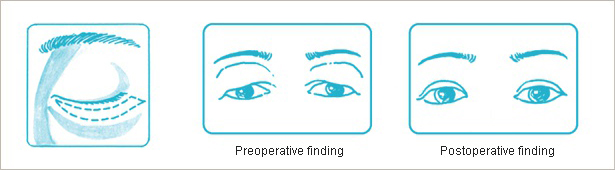 Postoperative finding