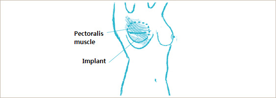 Reconstruction modality - Implant