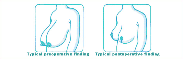 Reduction mammaplasty