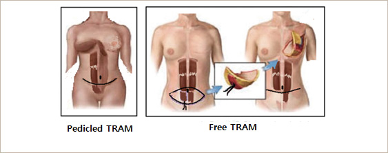 Transverse Rectus abdominis musculocutaneous flap