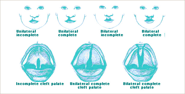 What is cleft