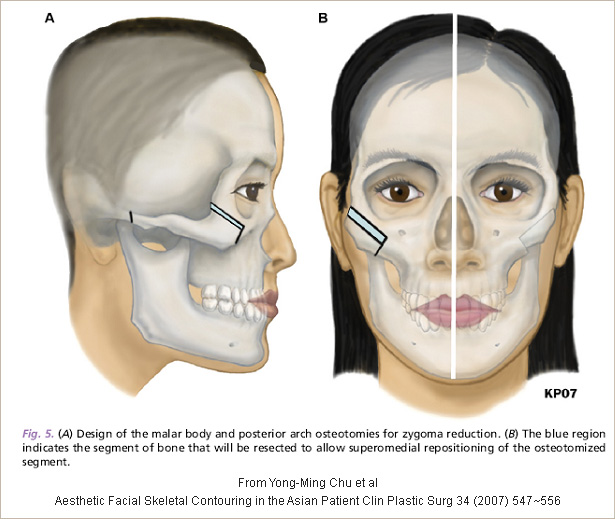 Zygoma reduction